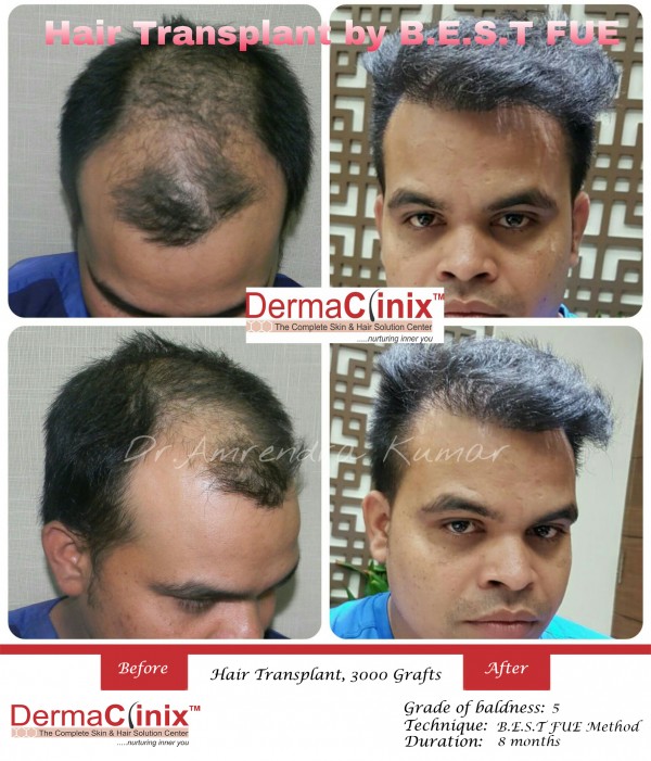 Hair Transplant in Ranchi