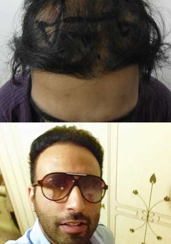 Hair Transplant In India Hair Restoration In Ludhiana
